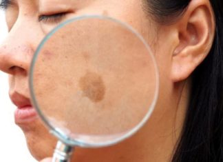 6 Ways to Remove Age Spots for a Brighter Complexion