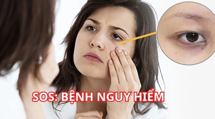 Why are you getting dark circles under your eyes? What other conditions can cause them?