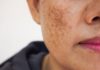 4 Most Effective Therapies to Get Rid of Melasma Today