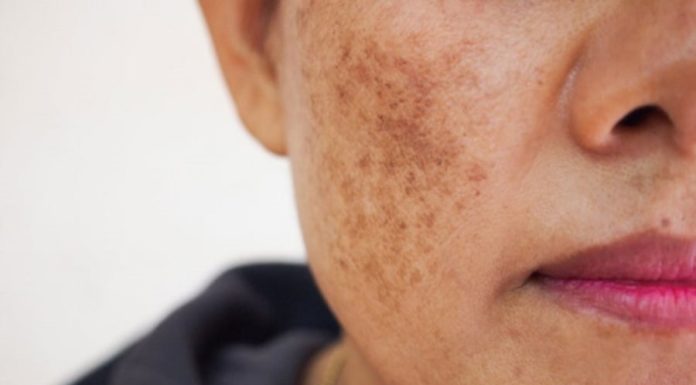 4 Most Effective Therapies to Get Rid of Melasma Today
