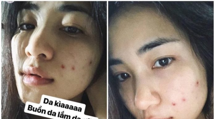 Hoang Minzy’s flawless skin secret: Bye-bye acne with watercress