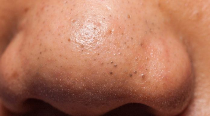 The Magic of Unclogging Pores: A Guide to Blackhead Banishment with Household Essentials