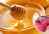 8 Ways to Heal Mouth Ulcers Effectively and Quickly