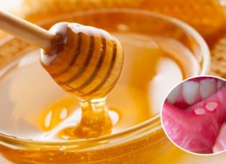 8 Ways to Heal Mouth Ulcers Effectively and Quickly