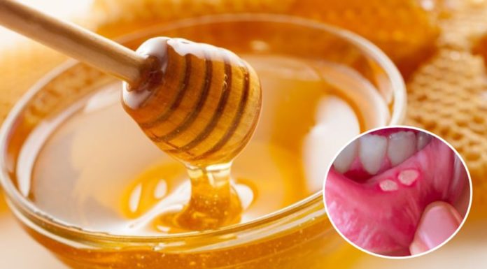 8 Ways to Heal Mouth Ulcers Effectively and Quickly