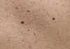 5 Easy Home Remedies to Remove Moles in a Day