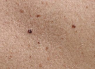 5 Easy Home Remedies to Remove Moles in a Day
