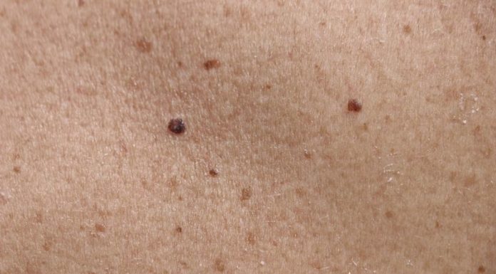 5 Easy Home Remedies to Remove Moles in a Day