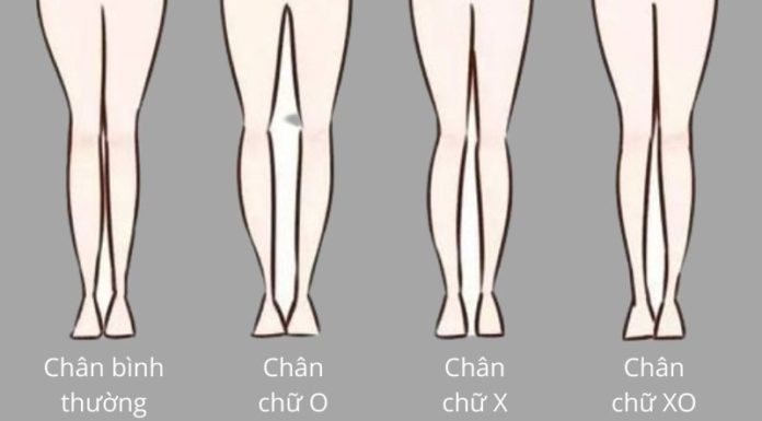 10 Simple Home Remedies to Fix Bow Legs in Adults