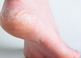 10 Effective Ways to Combat Dry Hands and Feet This Winter