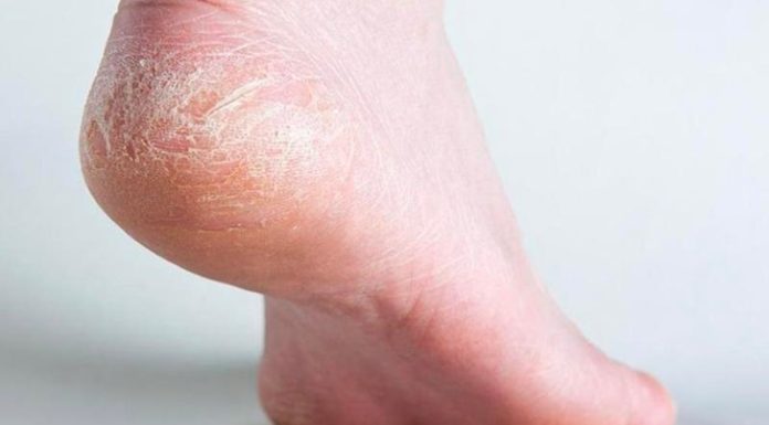 10 Effective Ways to Combat Dry Hands and Feet This Winter
