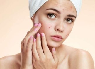 5 Natural Home Remedies for Acne-Prone Skin