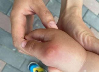 Does Saliva Help Mosquito Bites? 7 Uncommon Tips to Soothe the Itch