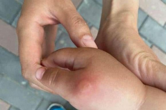 Does Saliva Help Mosquito Bites? 7 Uncommon Tips to Soothe the Itch