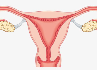 Eat More Fruit, Worry Less About Uterine Fibroids