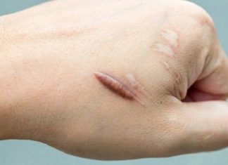 Does Eating Water Spinach Cause Keloid Scars?