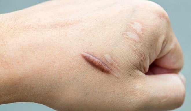 Does Eating Water Spinach Cause Keloid Scars?