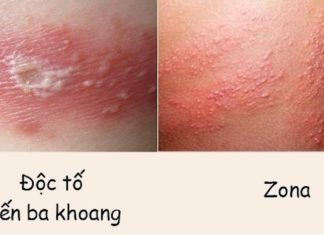 The Art of Insect Bite Diagnosis: A Doctor’s Guide to Unraveling the Mystery of Enigmatic Wounds.