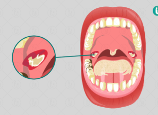 What is Diphtheria and How is it Transmitted?