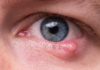 What to Eat and Avoid When You Have a Stye?