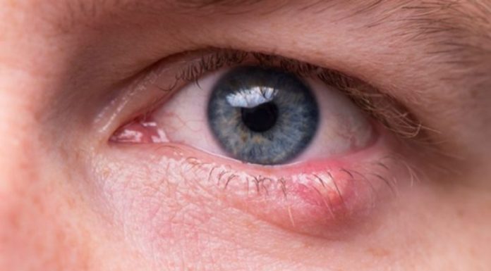 What to Eat and Avoid When You Have a Stye?