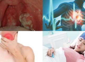 Signs and Symptoms of Diphtheria