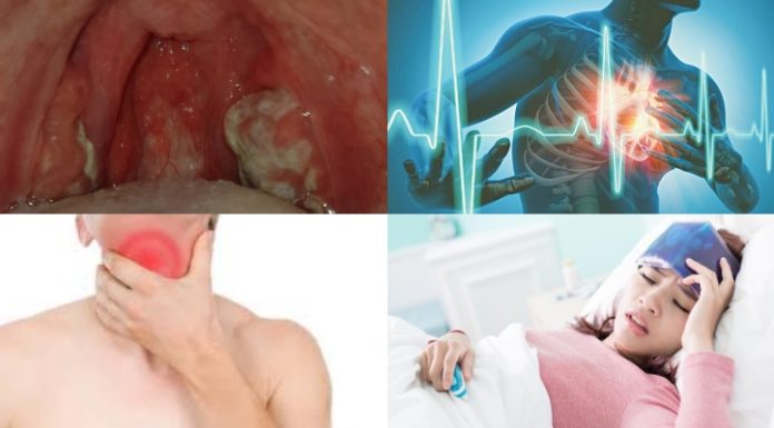 Signs and Symptoms of Diphtheria