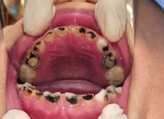 The Tooth Decay Troubles: Uncovering the Causes and Prevention for Little Ones’ Dental Health