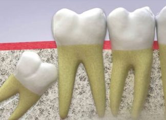 The Ultimate Guide to Toothbrush Techniques Post-Wisdom Tooth Extraction