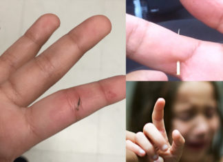 8 Pain-Free and Effective Tips to Remove Splinters from Your Fingers