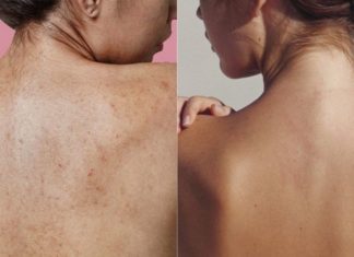 The All-Natural Acne Solution: Craft a Soothing Clay and Apple Cider Vinegar Body Spray