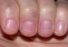 The Secrets Your Fingers Hold: Two Unassuming Signs That Reveal Serious Health Issues