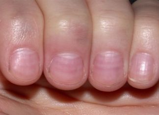 The Secrets Your Fingers Hold: Two Unassuming Signs That Reveal Serious Health Issues