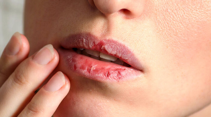 “The Pitfalls of Overusing Lip Balm: Why Less is More for Healthy Lips.”