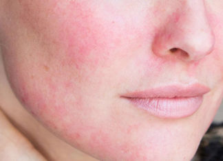 “Is Your Skin Reacting to Niacinamide Serum? Tips for Calming Redness and Sensitivity.”