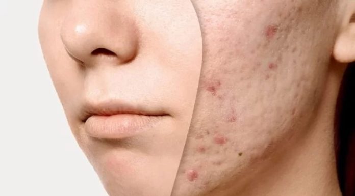 7 Miracle Ingredients to Transform Your Skin and Minimize Pores