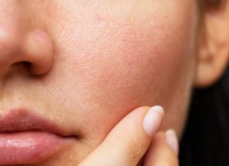 5 Simple Hacks to Shrink Those Enlarged Pores