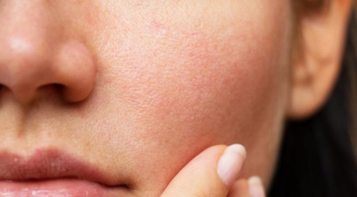 5 Simple Hacks to Shrink Those Enlarged Pores