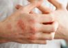 “3 Tips to Help Combat Hand Eczema When Doing Chores”