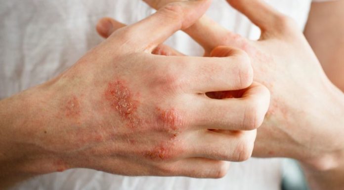 “3 Tips to Help Combat Hand Eczema When Doing Chores”