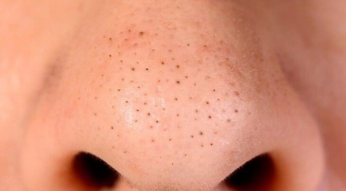 The Ultimate Guide to Blackheads: Everything You Need to Know