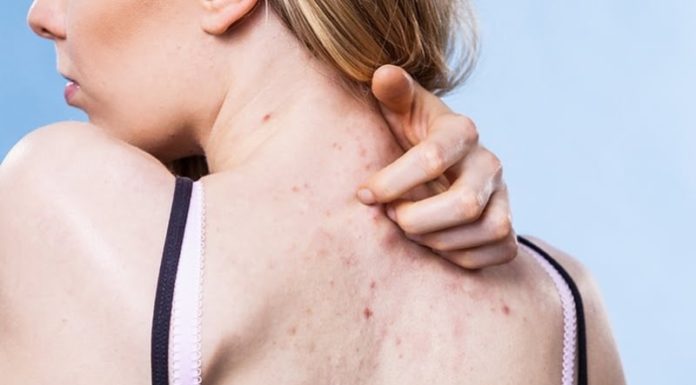 “Say Goodbye to Summer Backne: A Guide to Clear, Glowing Skin”