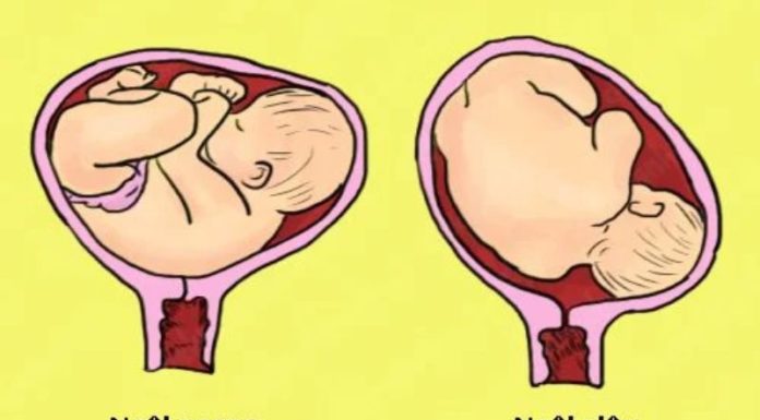 What is a Transverse Lie? Understanding Transverse Lie and What to Do.