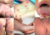 Hand, Foot, and Mouth Disease in Children: Causes and Prevention