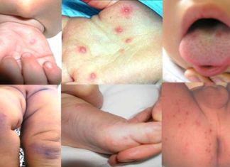 Hand, Foot, and Mouth Disease in Children: Causes and Prevention