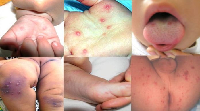 Hand, Foot, and Mouth Disease in Children: Causes and Prevention