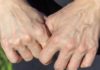 Is Visible Blue Veins on Hands and Feet a Sign of an Underlying Health Condition?