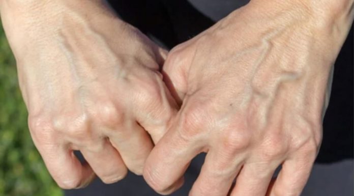 Is Visible Blue Veins on Hands and Feet a Sign of an Underlying Health Condition?