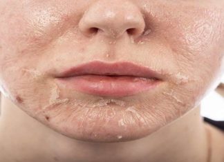 The Magic of Glycolic Acid Peels: Unveiling the Secrets for Glowing Skin