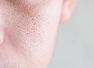 The Ultimate Guide: 5 At-Home Solutions to Smooth Out Scarred Skin